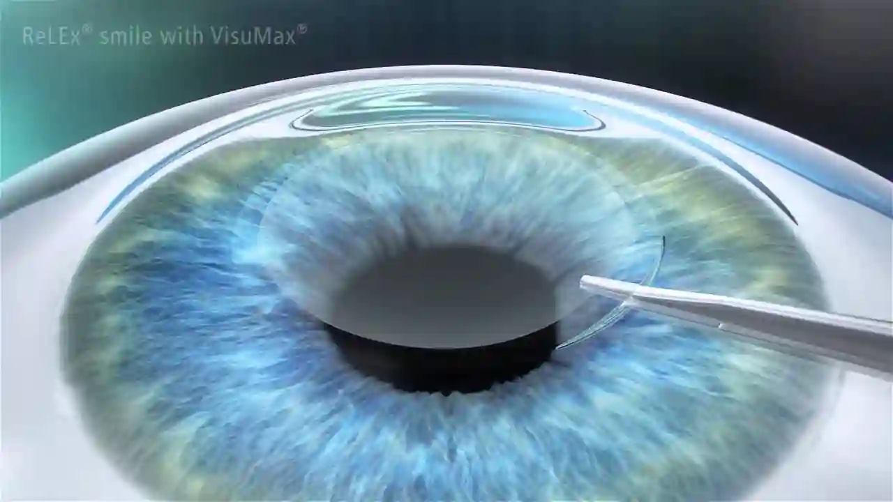 How To SMILE Eye Surgery